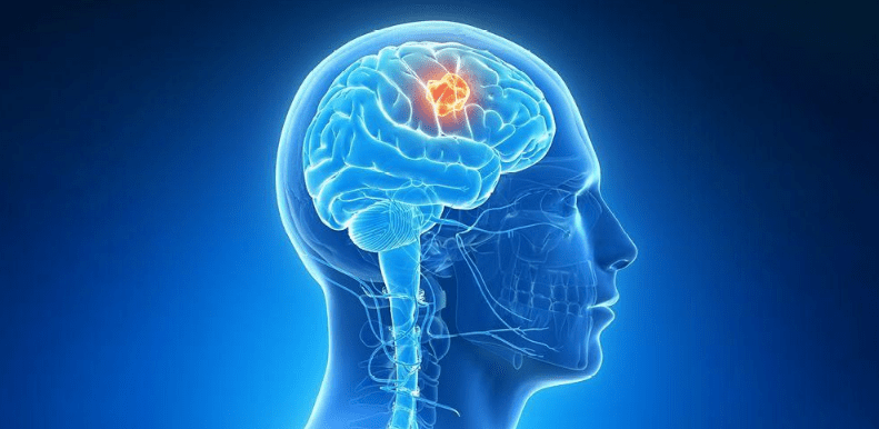 Tips Mencegah Serangan Penyakit Kanker Otak